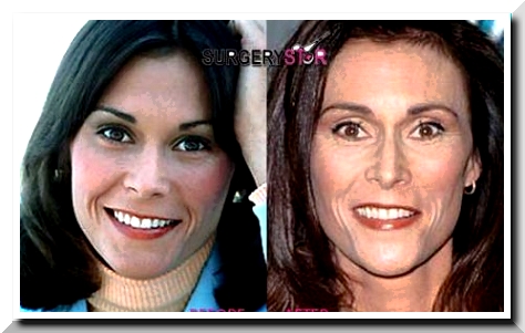 kate jackson plastic surgery before and after